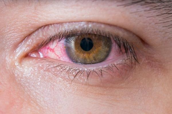 شیوع آلرژی چشمی در فصل بهار ، درمان فقط تحت نظر چشم پزشک باشد