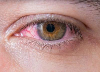 شیوع آلرژی چشمی در فصل بهار ، درمان فقط تحت نظر چشم پزشک باشد
