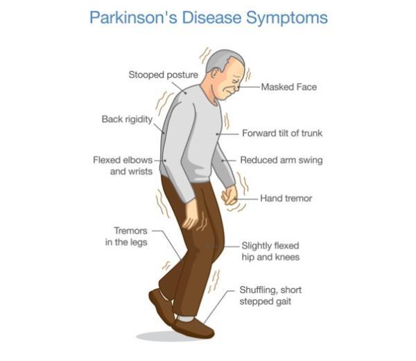 با یک آزمایش نو، بیماری پارکینسون را می توان 7 سال قبل از بروز علائم آن تشخیص داد