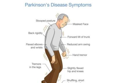 با یک آزمایش نو، بیماری پارکینسون را می توان 7 سال قبل از بروز علائم آن تشخیص داد